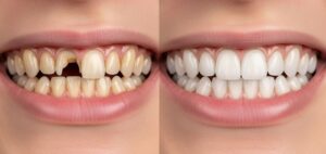 Before and after image of a smile makeover, showing misaligned and yellow teeth transformed into a perfect, bright, and straight smile.
