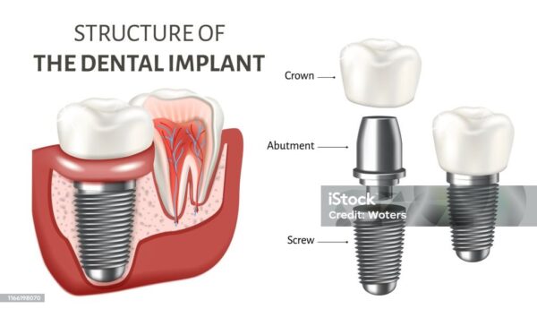 Diagram of a dental implant procedure in Onehunga with the post, abutment, and crown